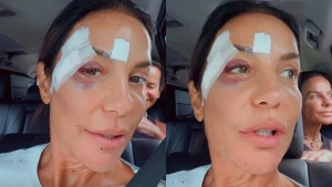 Com rosto machucado, Ivete Sangalo volta ao hospital e passa por cirurgia